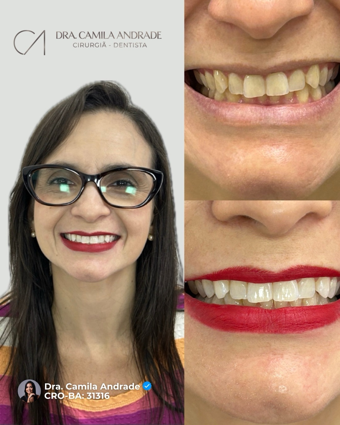 Harmonização do sorriso